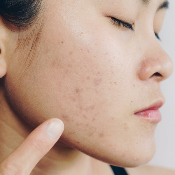 How to Get Rid of Acne Scars & Fade – Dr. Zenovia
