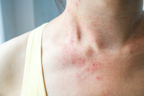 Eczema: Symptoms, Treatments, Prevention – Dr. Zenovia