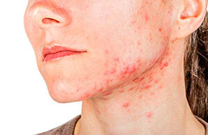 What Causes Cystic Acne