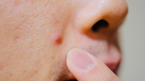 acne blemish on a face