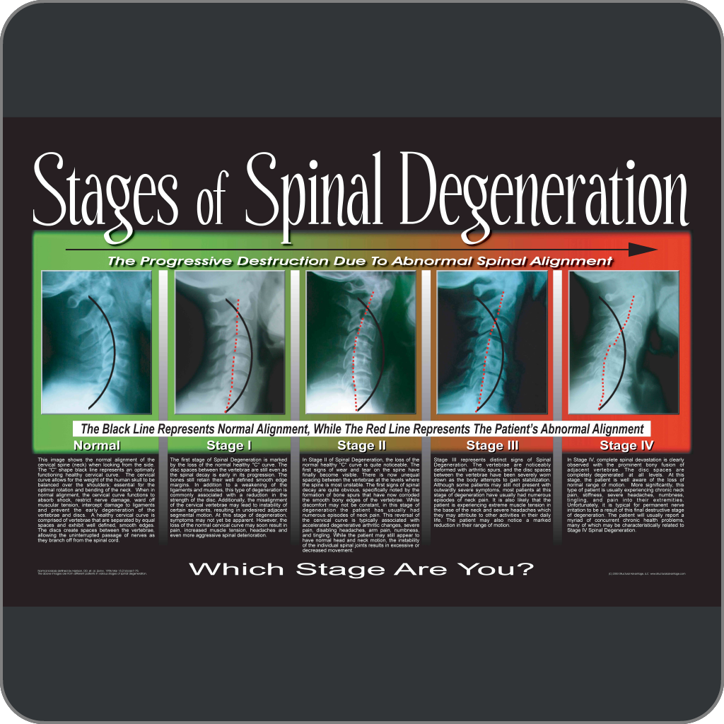 Stages Of Spinal Degeneration Poster Mind Virus