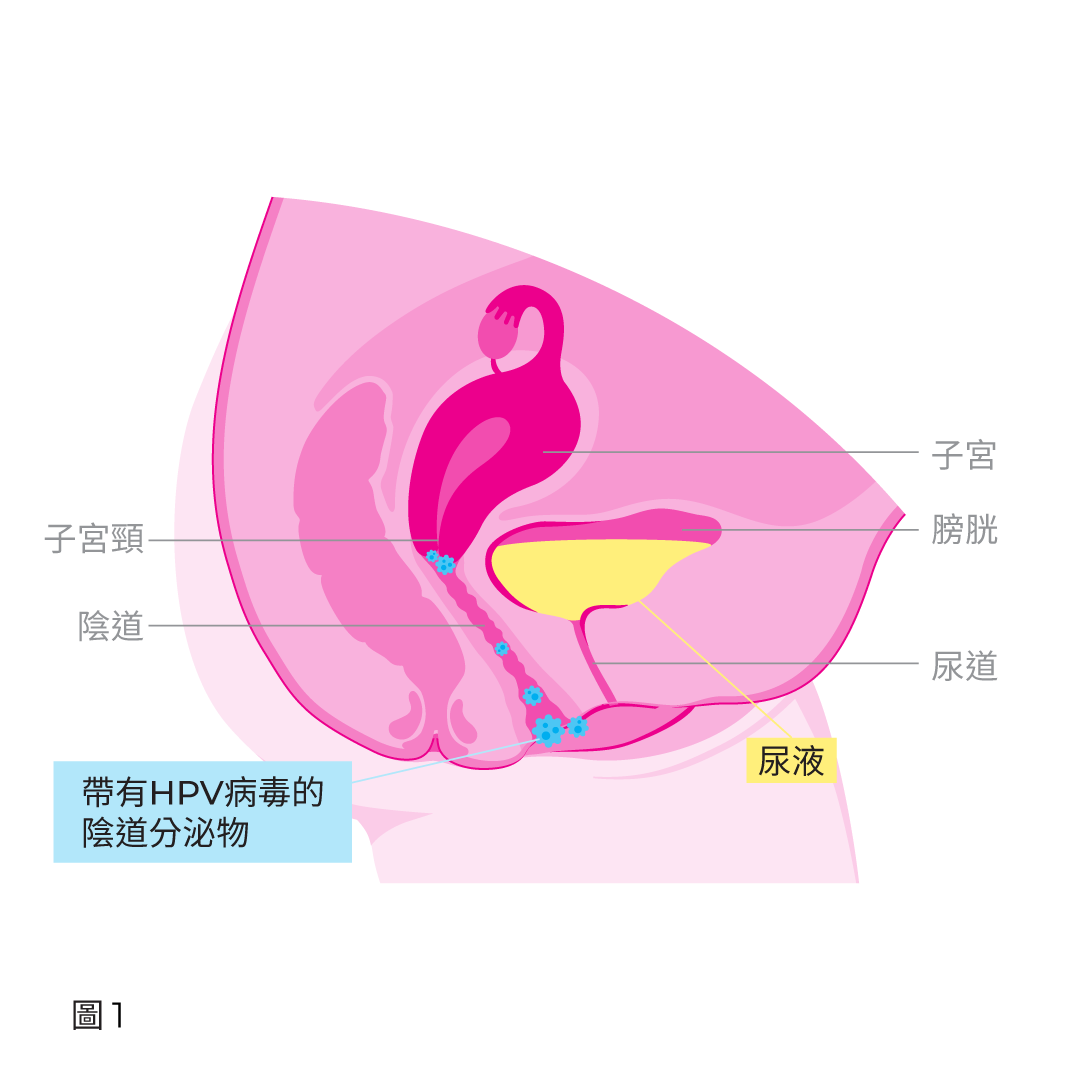 Vaginal secretions with HPV