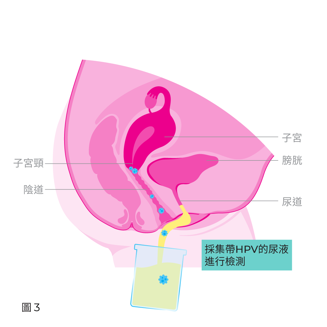 採集帶HPV病毒的尿液進行檢測
