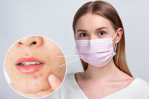 Maskne - Pickel und Akne durch Masken tragen - vermeide Hautunreinheiten