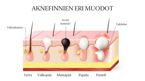 Aknefinnien eri muodot
