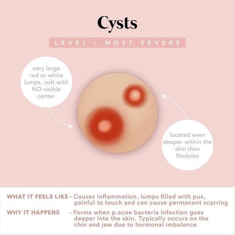 Cysts