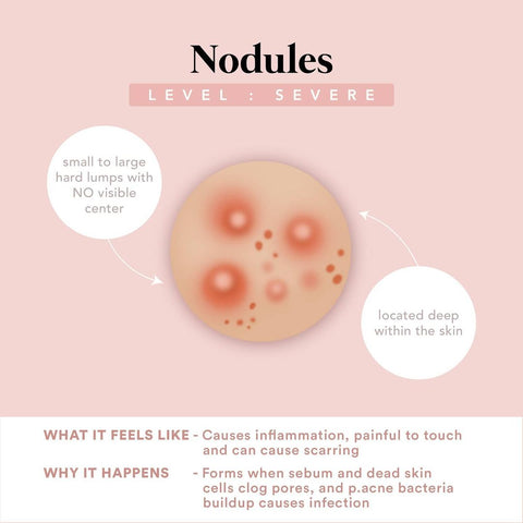 Nodules