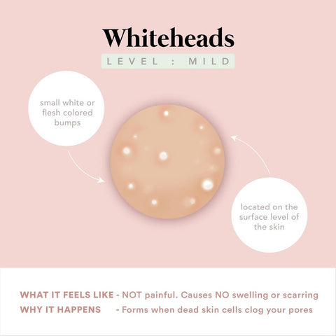 Whiteheads