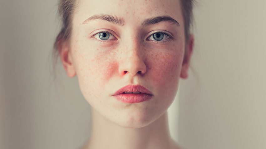 natural rosacea treatment