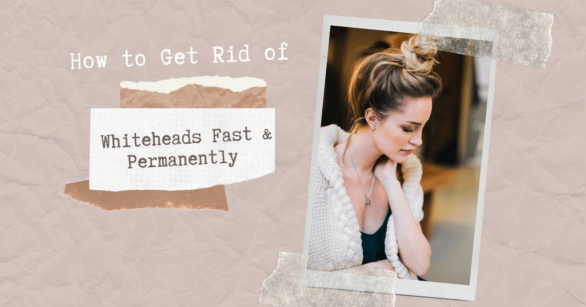 get rid of whiteheads fast and permanently with these tips