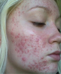 Ellie's acne-prone skin before Accumax