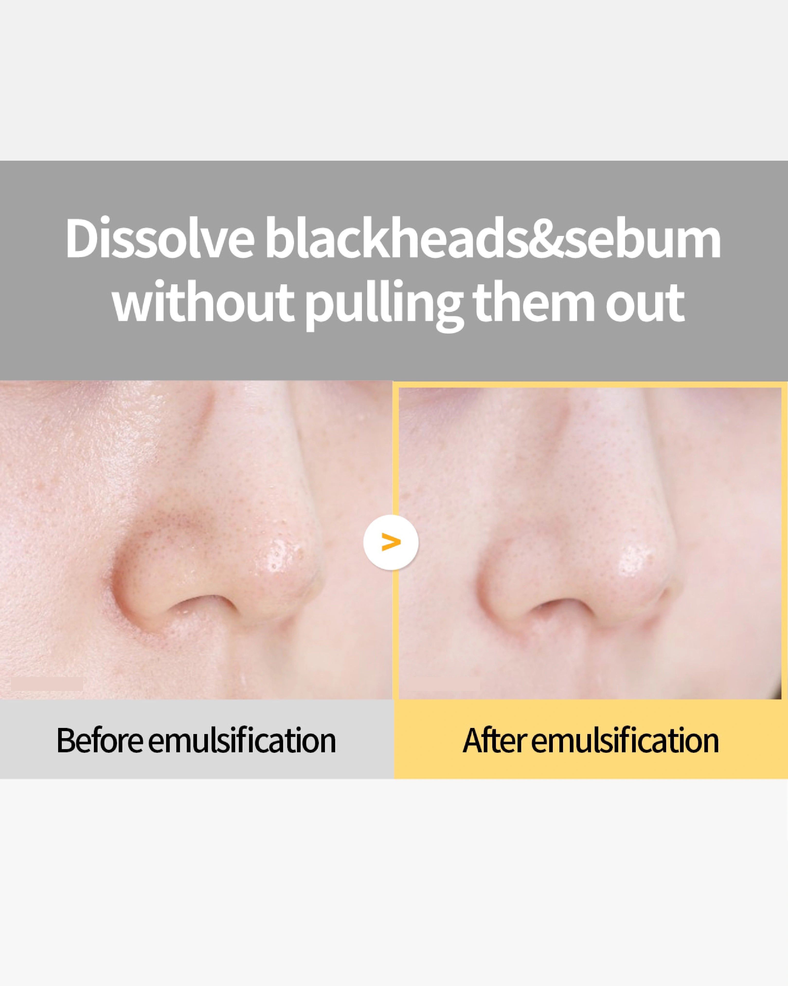 Before and after emulsification comparison of blackheads and sebum on skin.
