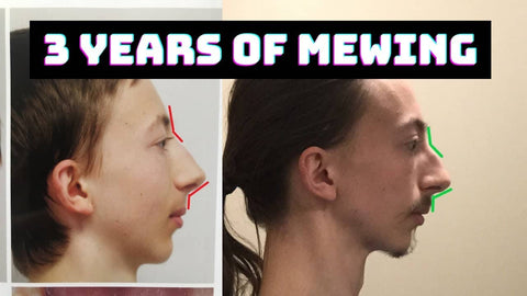 Mewing Before & After: 122+ Progress Photos (Male & Female Transformations)