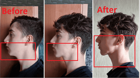 Mewing Side Profile Results - Before/Afters 