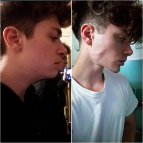 Mewing Side Profile Results - Before/Afters 