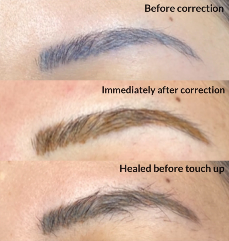 Permanent Makeup Correction and Removal  Pigmenta