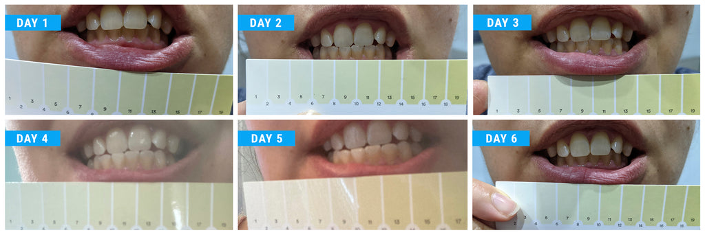 Is the Hismile Teeth Whitening Kit effective?