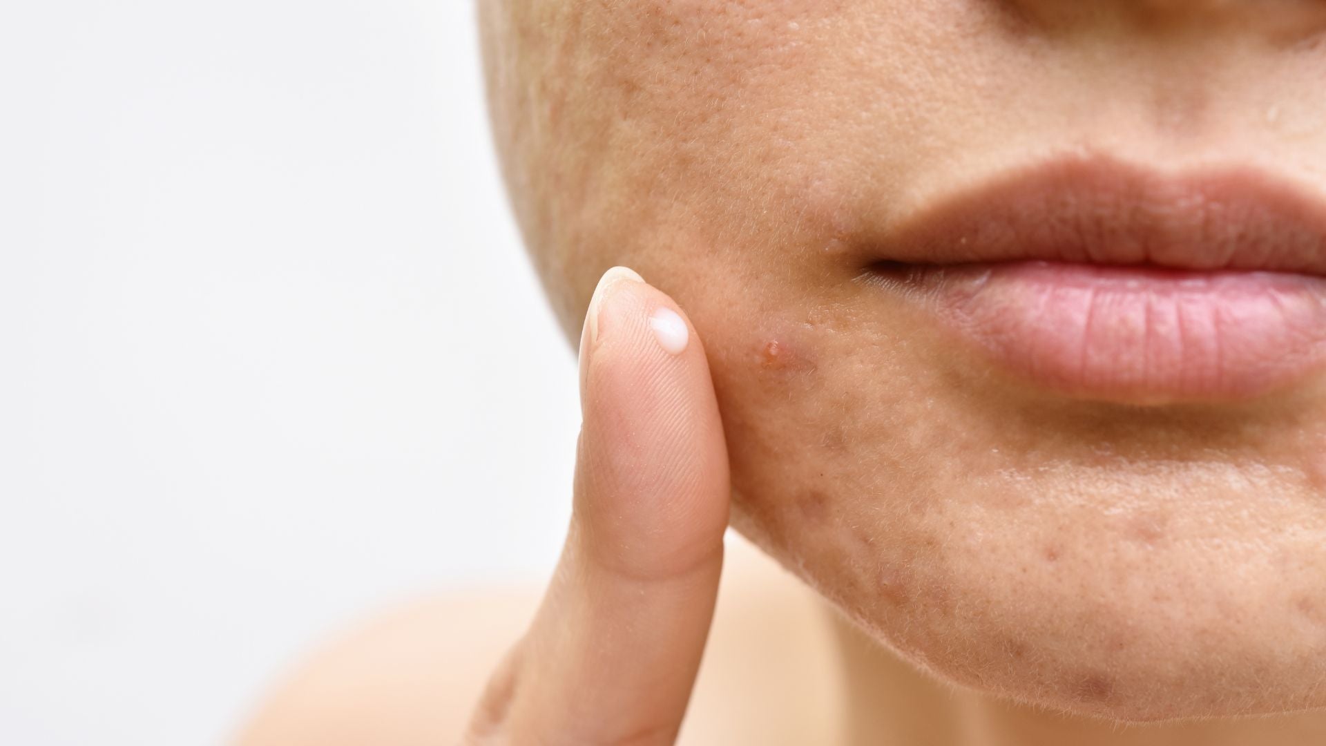 Close up of a woman's chin with acne on it