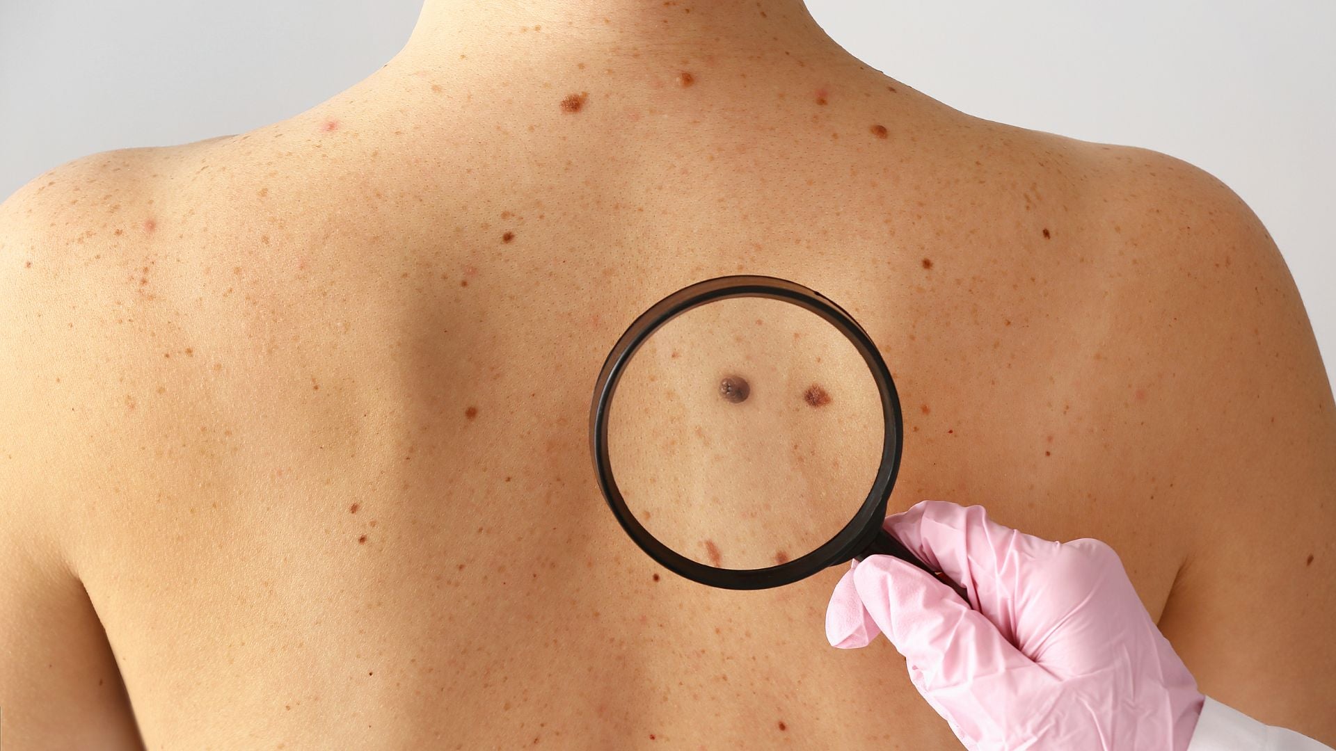 Magnifying glass to view moles on a person's back