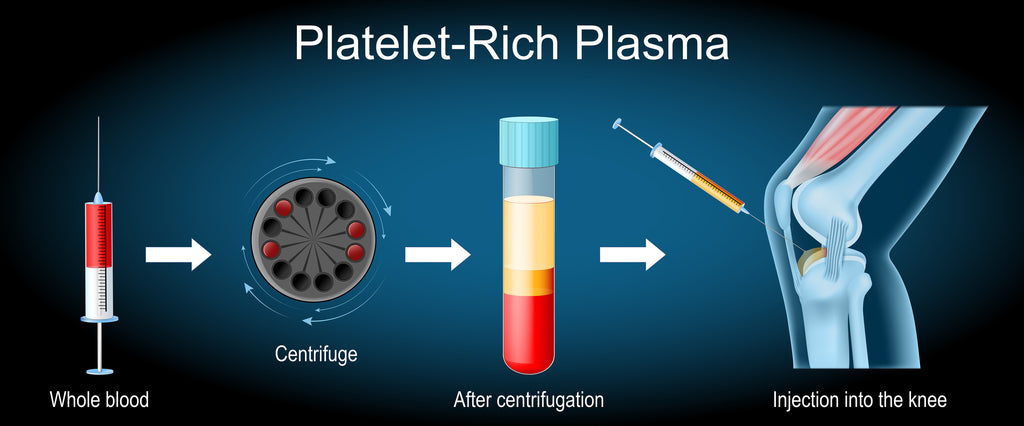 Platelet Rich Plasma PRP Therapy at NW Integrative Medicine