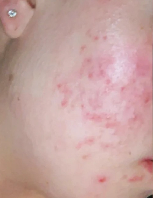 Skin Care Before