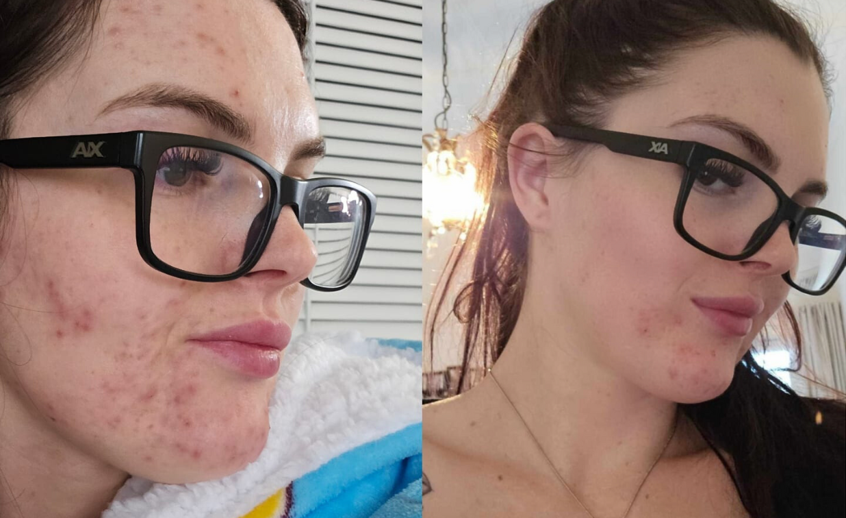 Side-by-side comparison showing improvement in skin condition on a woman's face.
