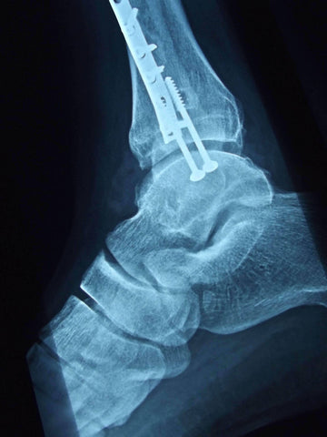 X ray of snowboard ankle injury_pinned