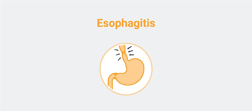 Esophagitis