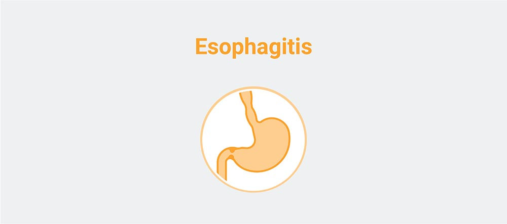 Esophagitis