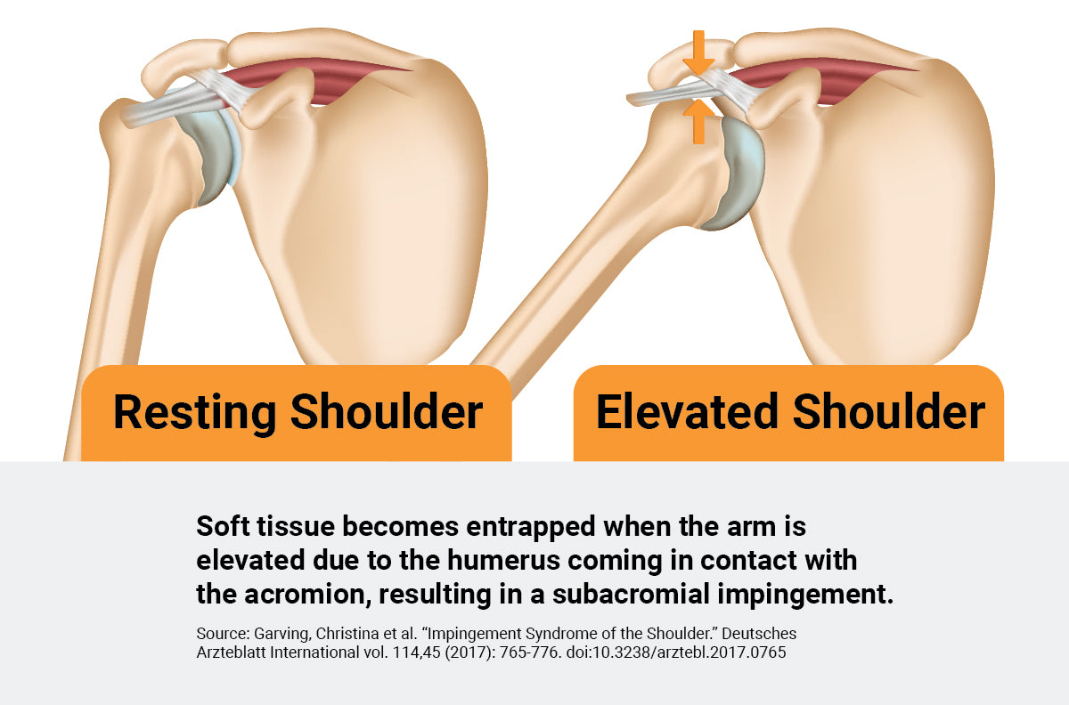 Why Does My Shoulder Hurt When I Lift My Arm? - CSC