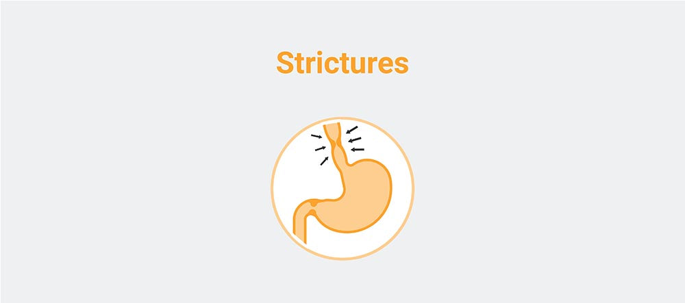 Strictures