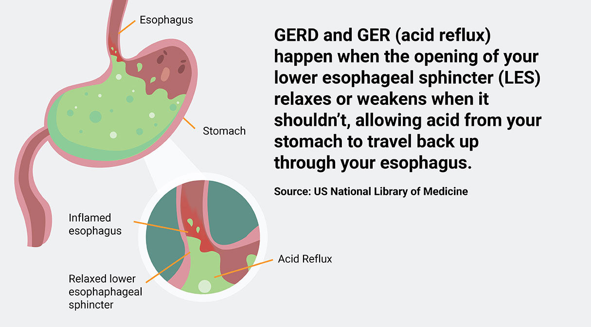 stomach and acid reflux infographic