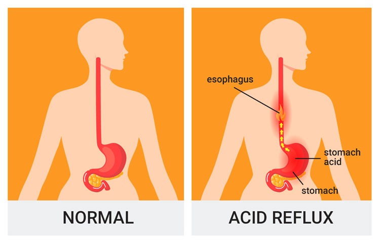 normal and reflux throat infographic