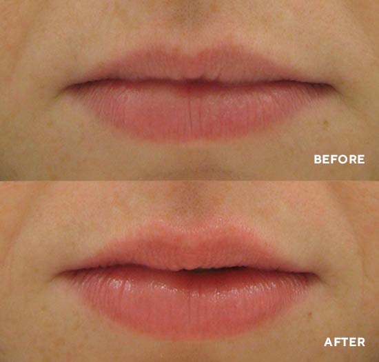 Lip Service – HydroPeptide