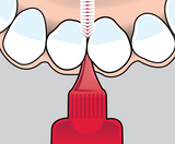 how_to_use_idb_1_front_teeth_1-2000px