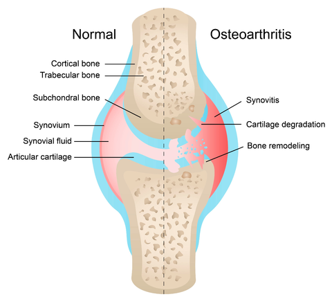 osteoarthritis vs normal