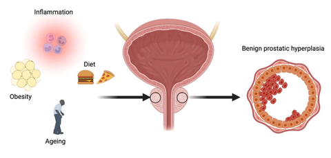 Benign Prostatic Hyperplasia