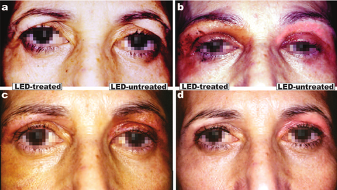 Red light acts on all phases of wound healing