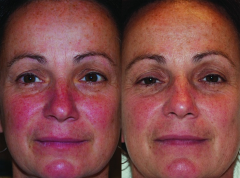 red and nir light therapy on acne healing
