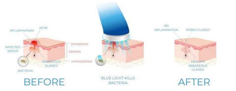 how blue light therapy work