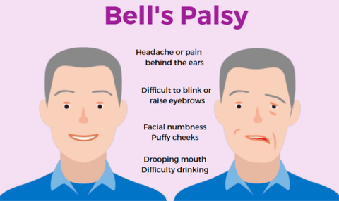 Pathways and Development of Bell's Palsy