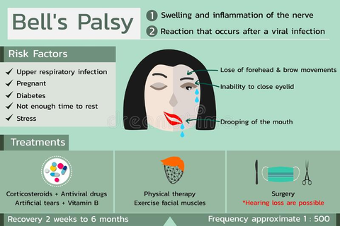 Other Treatments for Bell's Palsy