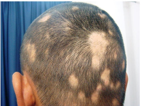 Risk Factors Associated With Alopecia Areata