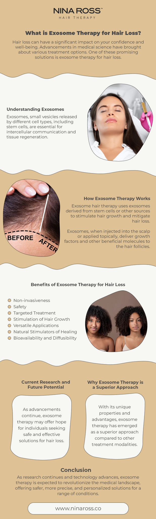 Exosome Therapy for Hair Loss