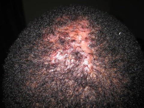 Symptoms Of Folliculitis