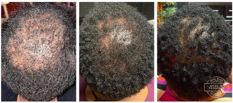 African American Trichologist Atlanta Female Progress Pic 2