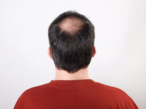 Male Pattern Baldness