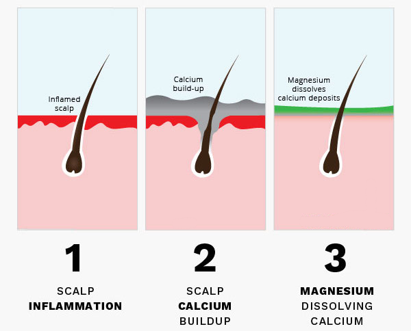 An illustration of how calcification affects hair loss