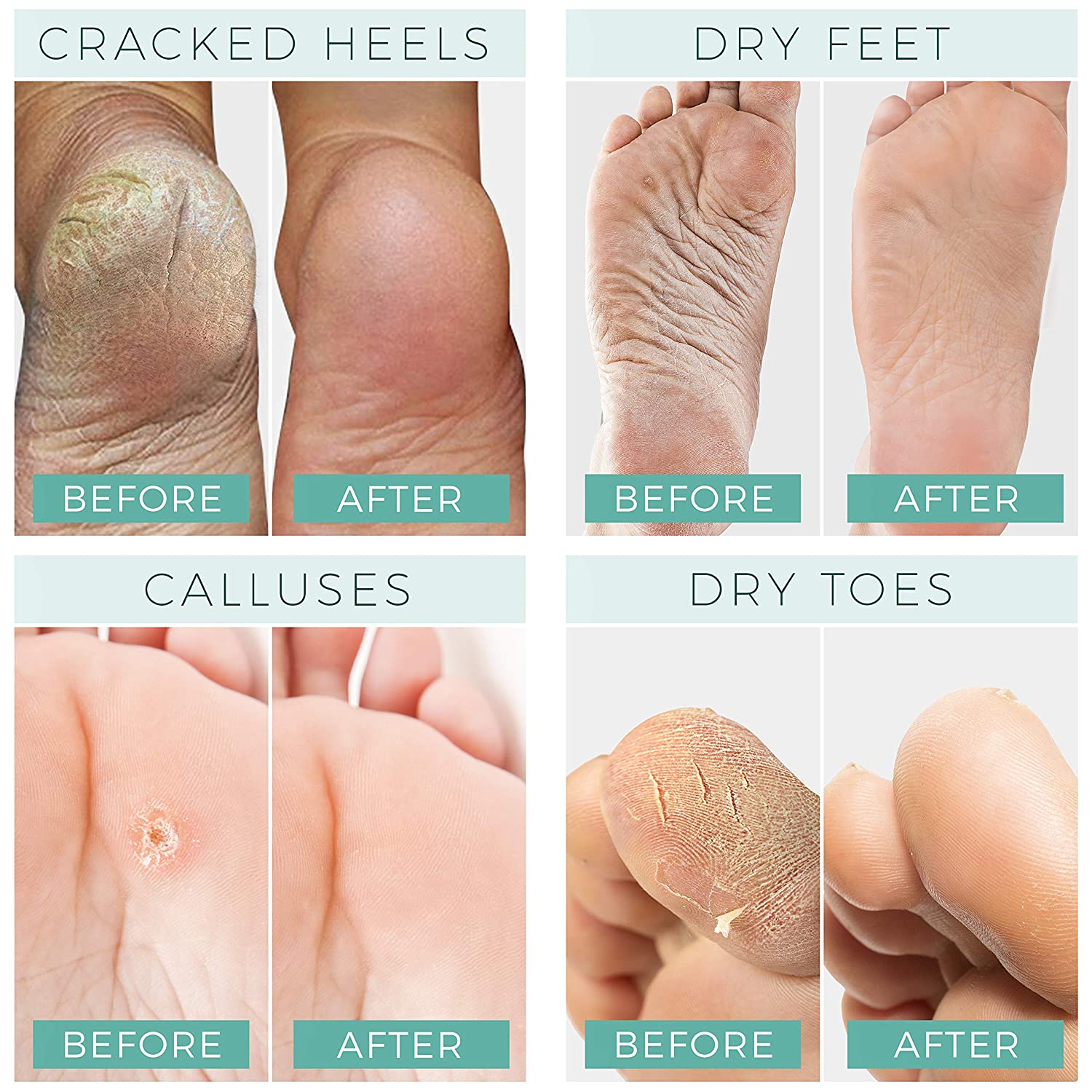 dry and peeling feet