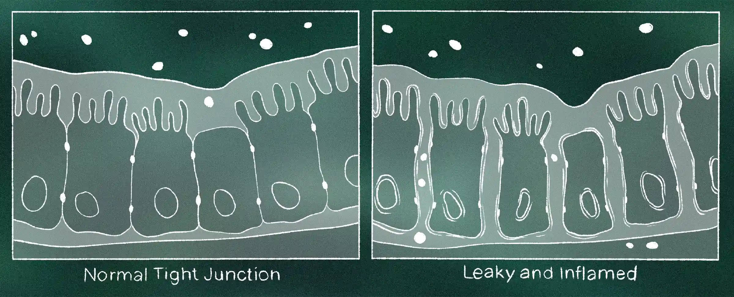 leaky-gut-normal-tight-junction-leaky-and-inflamed